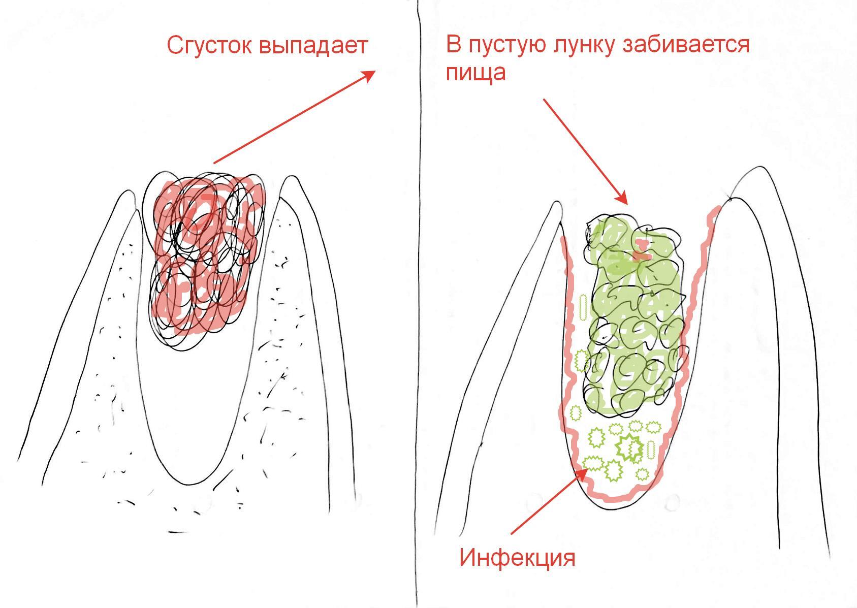 Сага о стоматологии. Глава 24. Что делать если сильно болит челюсть после  удаления зуба? Как лечить альвеолит лунки? | Пикабу