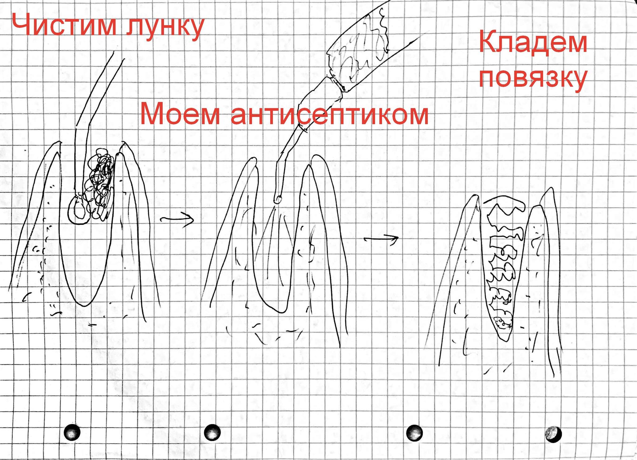 Сага о стоматологии. Глава 24. Что делать если сильно болит челюсть после  удаления зуба? Как лечить альвеолит лунки? | Пикабу