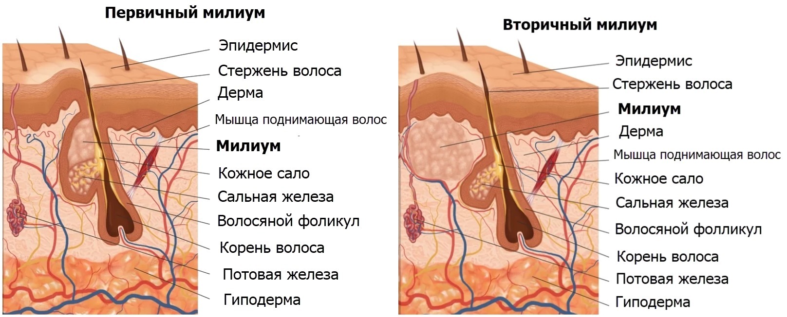 Статья по запросу: Милиумы | Пикабу