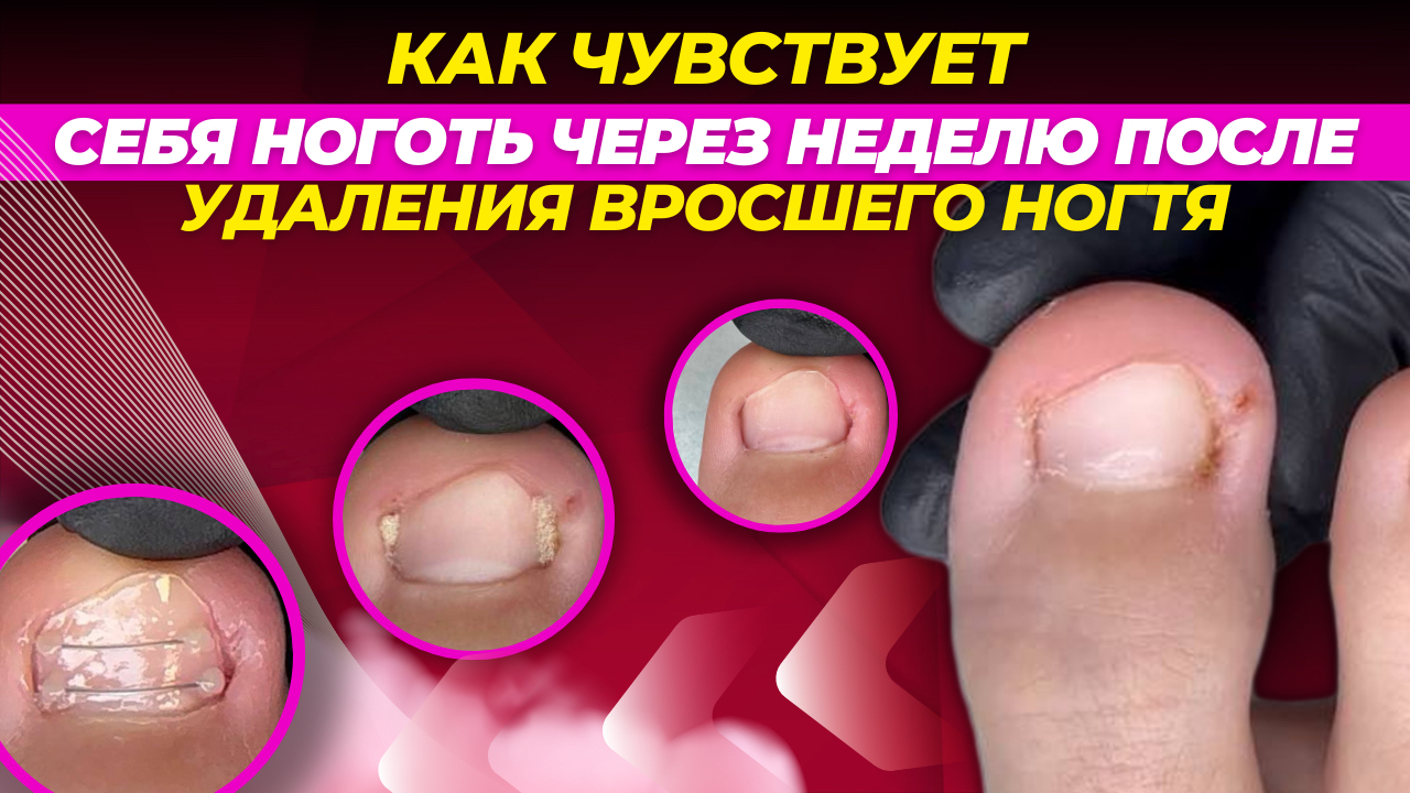 Как чувствует себя ноготь через неделю после удаление вросшего! | Пикабу