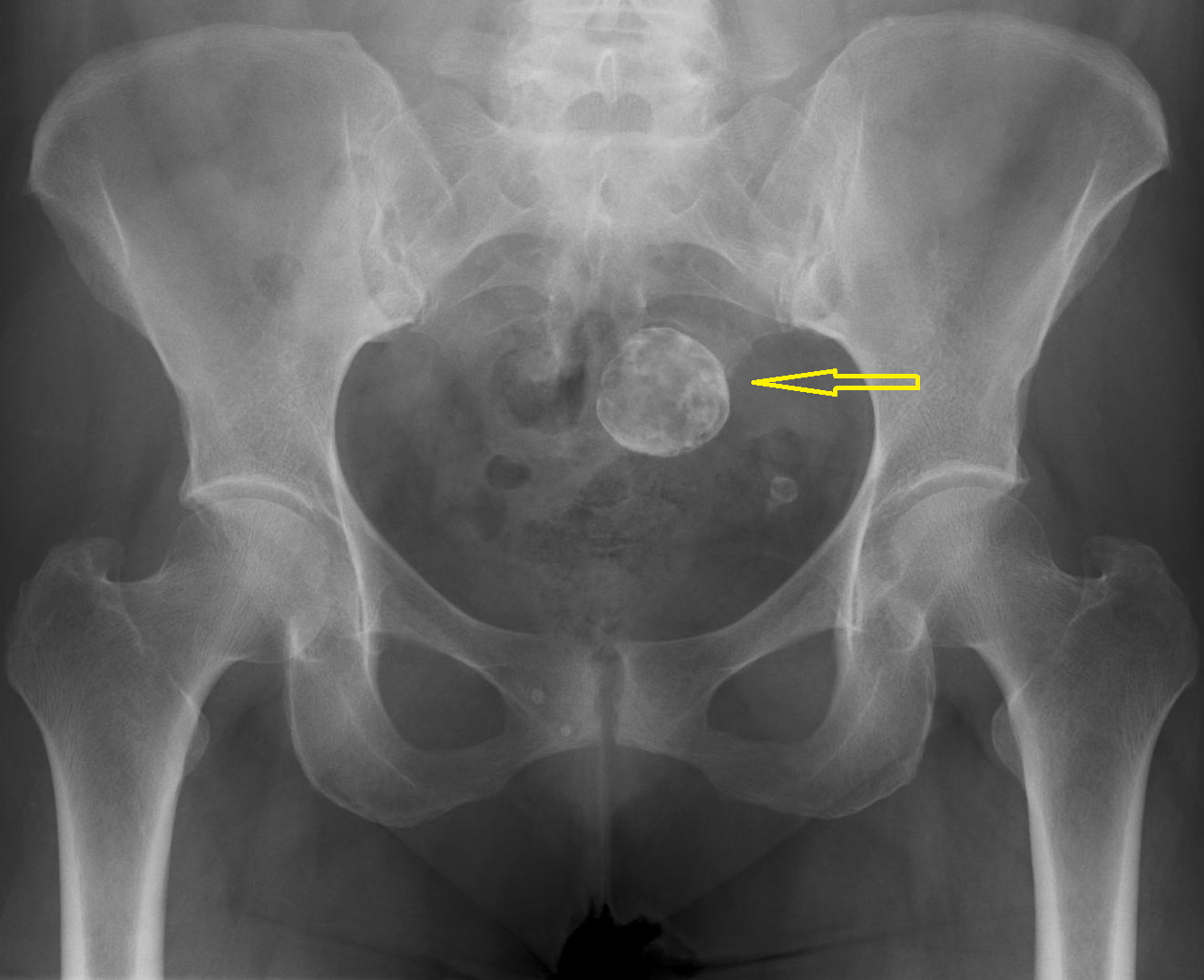 Записки рентгенолога (часть 25). Миома матки, камни мочевого пузыря, культи  бедренных костей, обызвествление бедренных артерий | Пикабу