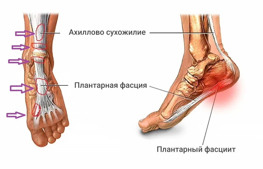 Плантарная ишемия