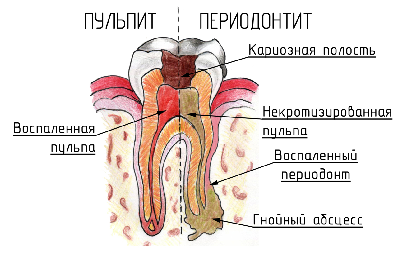 Периодонтит под микроскопом | Пикабу