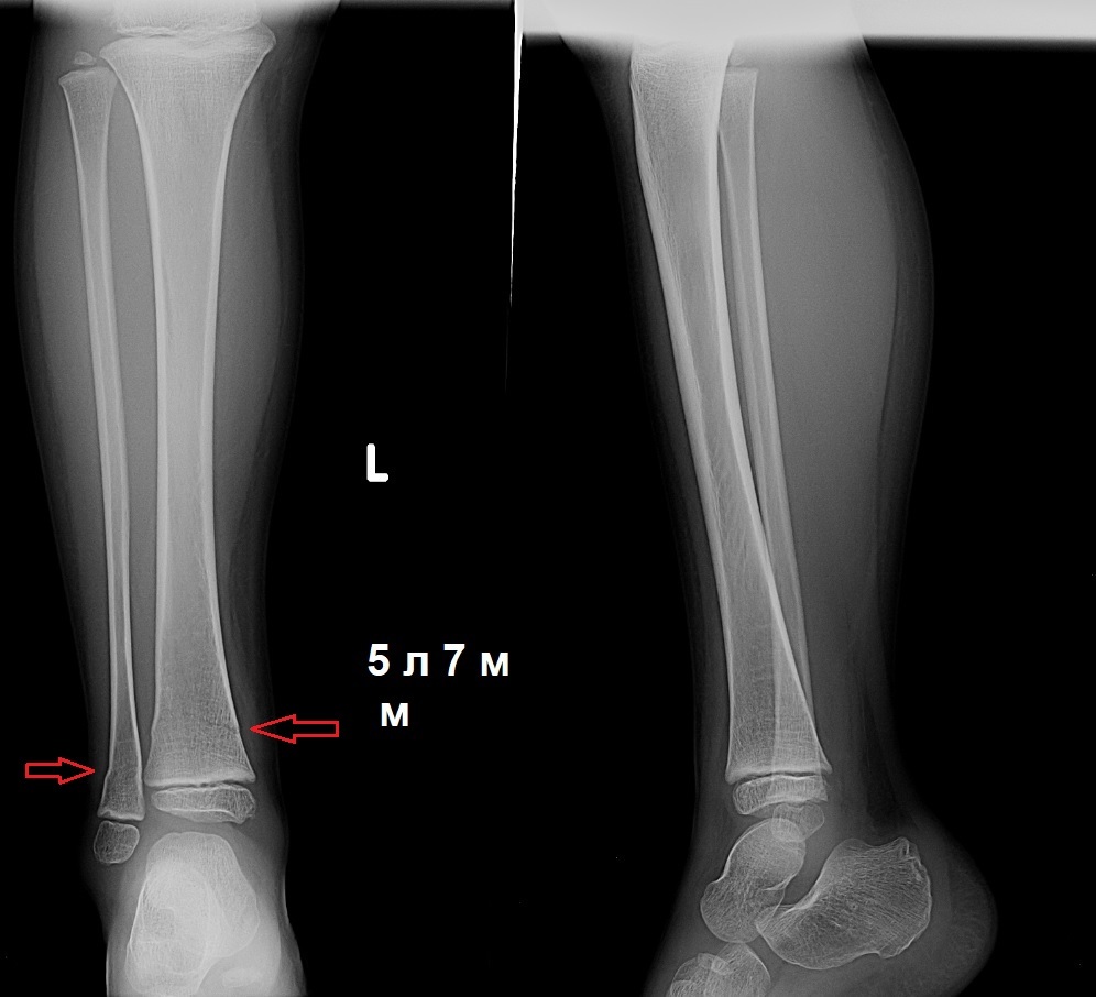 Травматолог о покатушках на велосипедном багажнике | Пикабу