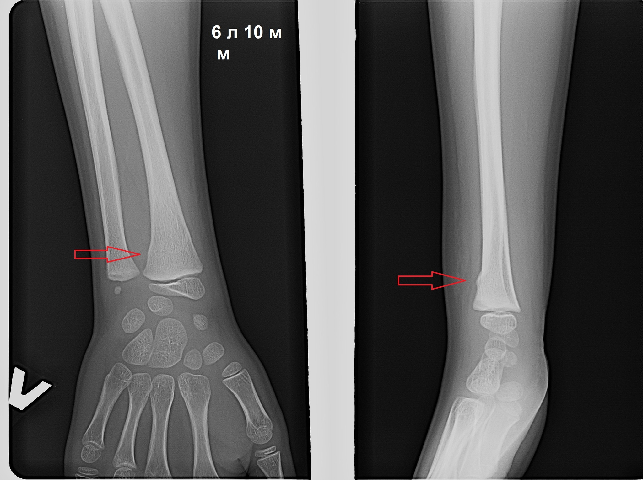 Травматолог о покатушках на велосипедном багажнике | Пикабу