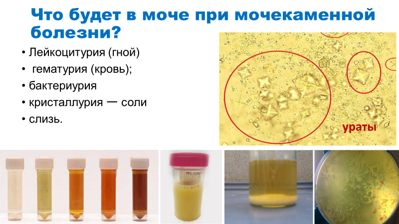 Мочекаменная болезнь