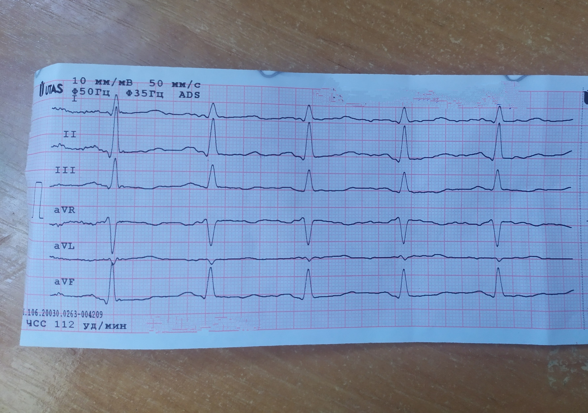 Помогите определить патологию сердца по ЭКГ. Также хотелось узнать что за  вид Тахакардии | Пикабу