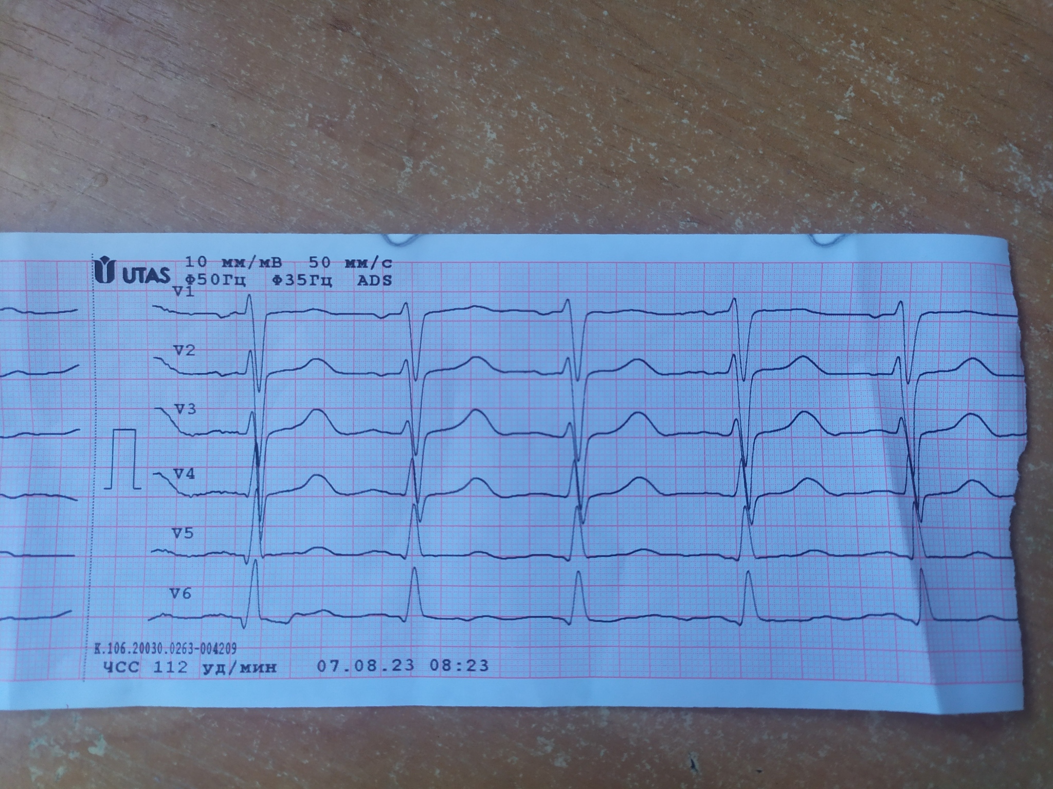 Помогите определить патологию сердца по ЭКГ. Также хотелось узнать что за  вид Тахакардии | Пикабу