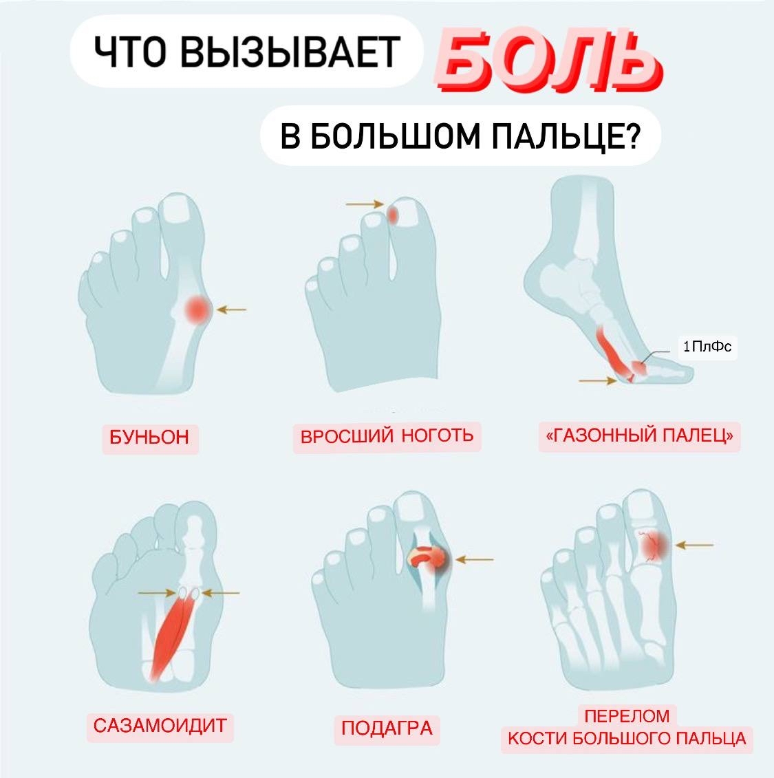 Большой палец стопы: 6 причин боли: | Пикабу