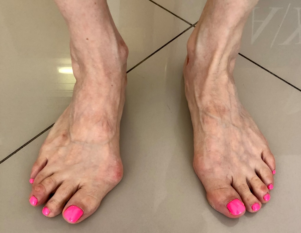 Лечение Hallux valgus оперативно по квоте в кратчайшие сроки | Пикабу