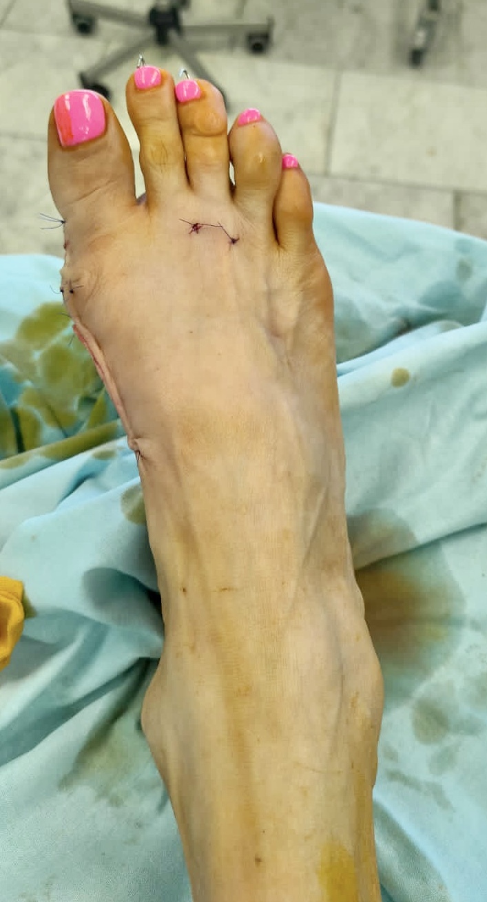 Лечение Hallux valgus оперативно по квоте в кратчайшие сроки | Пикабу