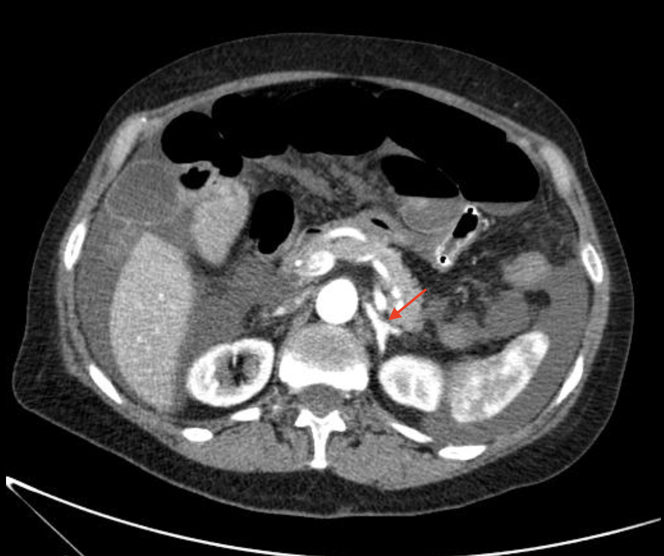 Случаи из практики: заворот кишок | Пикабу