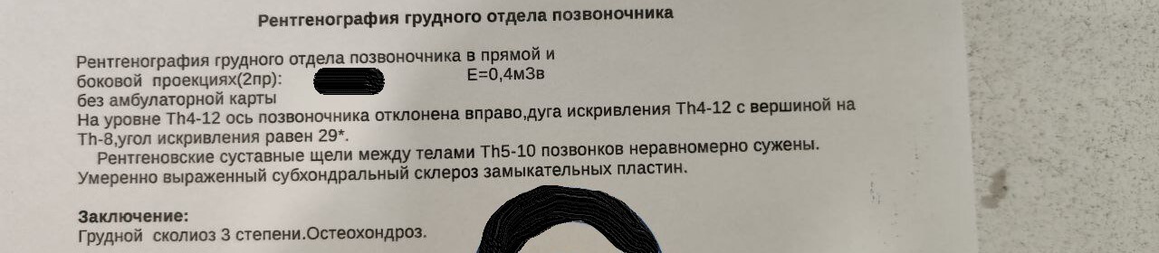Сколиоз грудного отдела позвоночника 3 степени | Пикабу