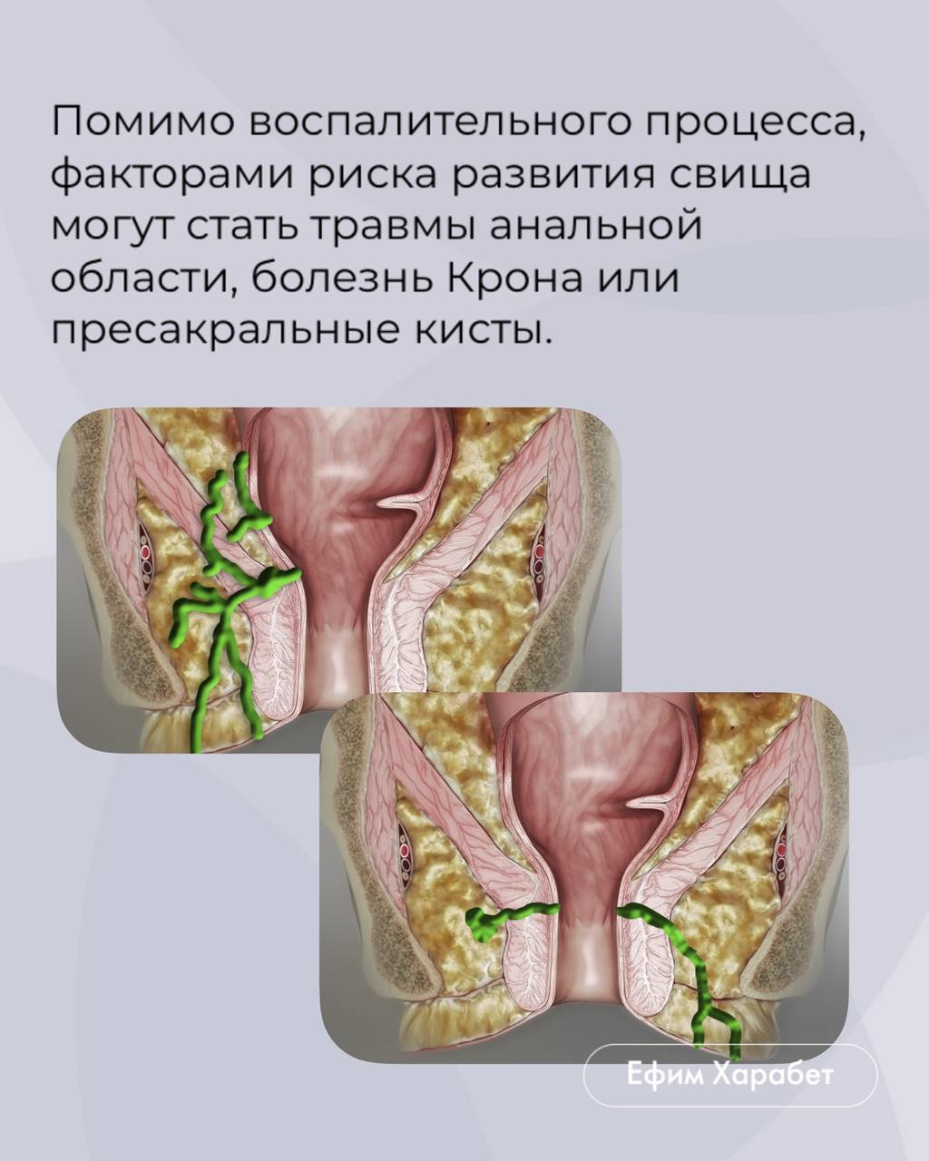 Свищ прямой кишки: Диагностика | Пикабу