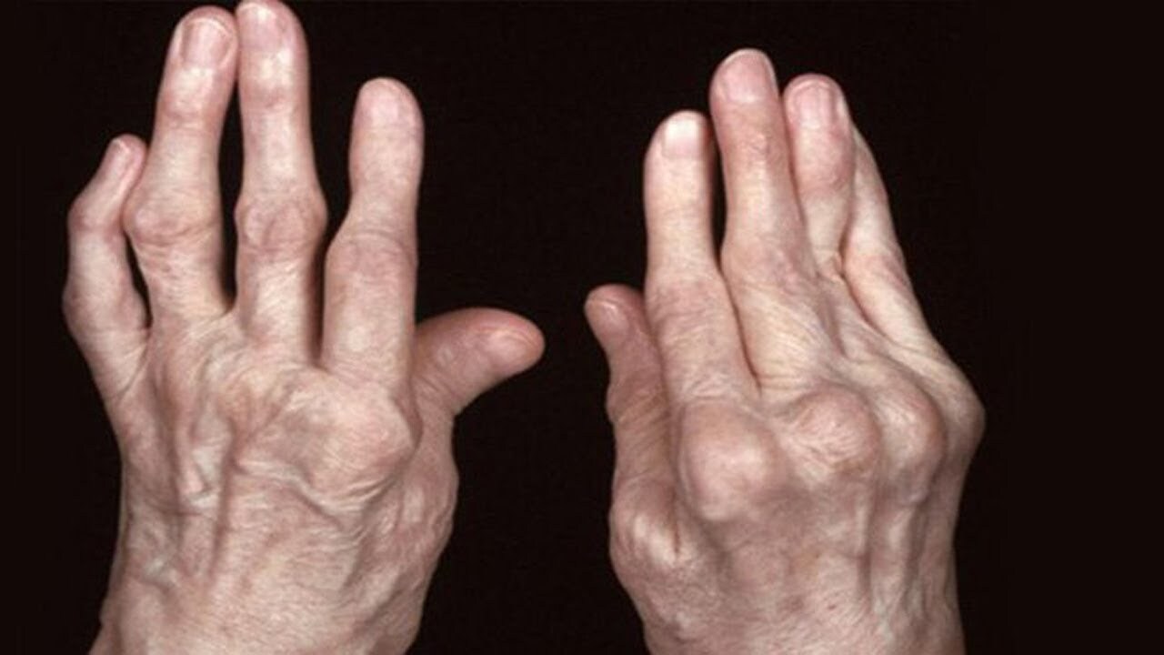 Суставы пальцев сильно. Ревматоидный артрит полиартрит. Прогрессирующий ревматоидный артрит. Ревматоидный артрит полиартрит олигоартрит. Реактивный и ревматоидный полиартрит.