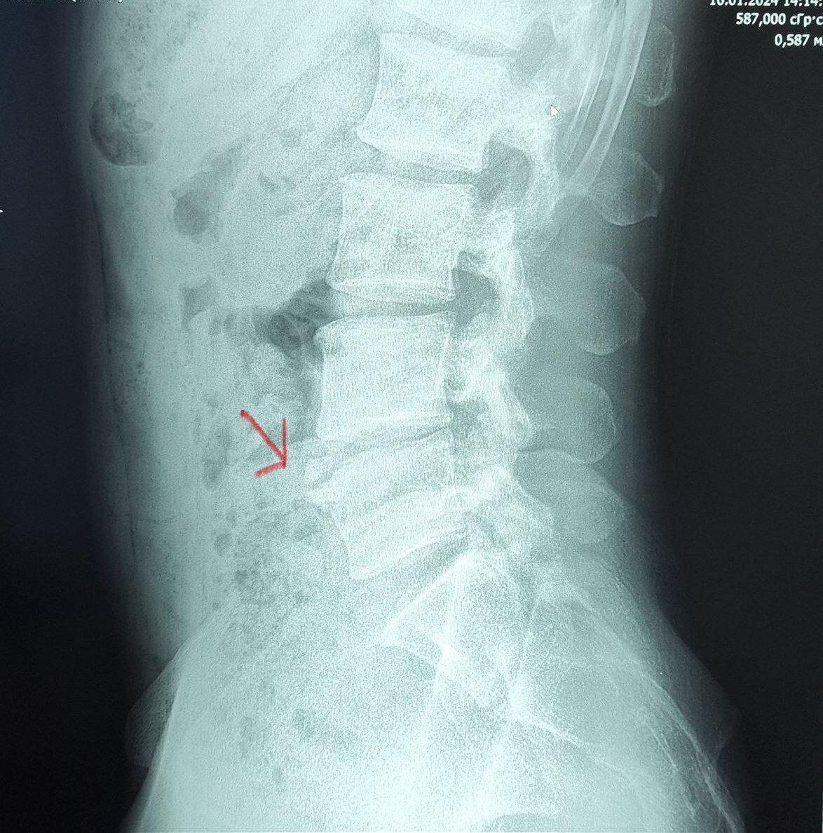 Персистирующий апофиз (Limbus vertebrae) | Пикабу