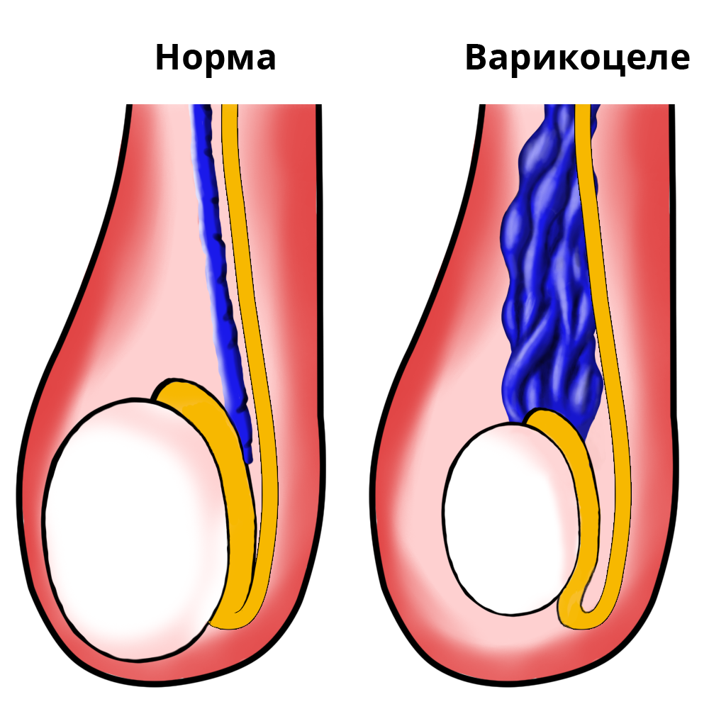 Когда нужно оперировать варикоцеле? | Пикабу