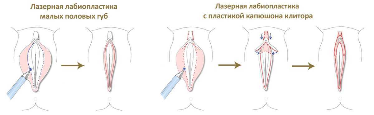 Малые половые губы наружу